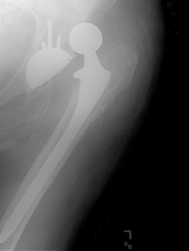 Femur Fractures can Lead to Amputation