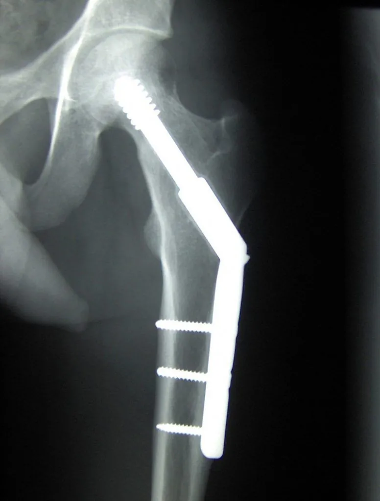 Infection Following a Femur Fracture