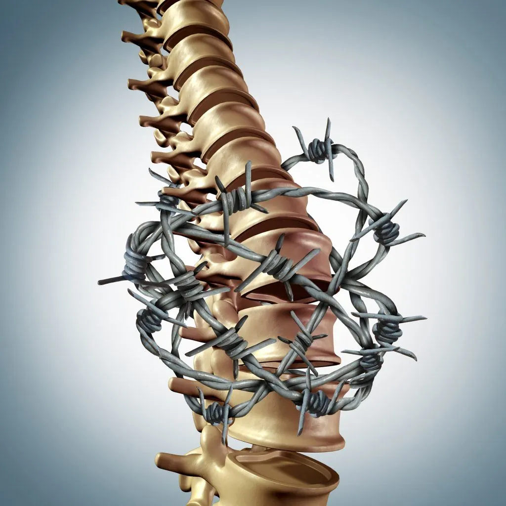 Epidural Hematoma of the Spine